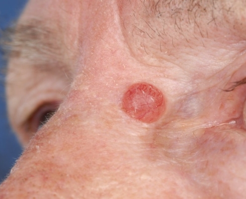 Een nodulair basaalcelcarcinoom op de neus - een vorm van huidkanker