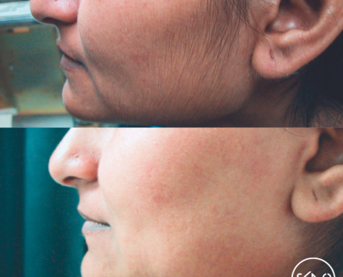 Voor en na laserontharen gezicht