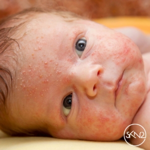 Neonatale acne bij baby in het gezicht